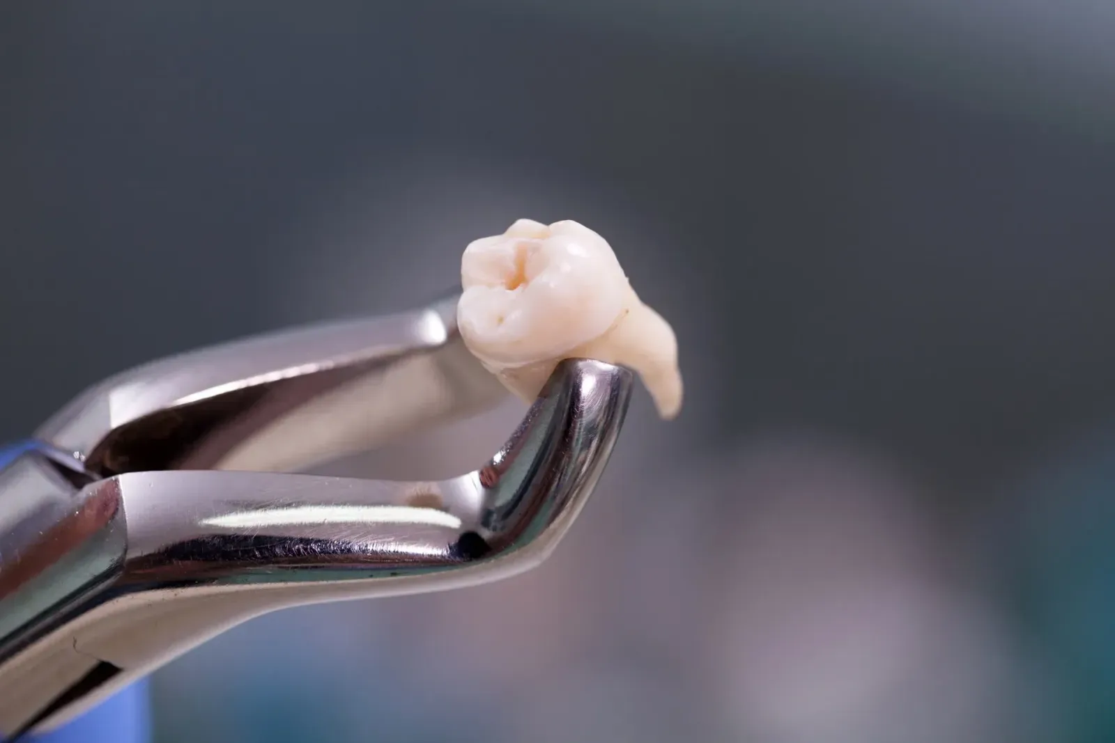 Illustration Of The Dental Extraction Procedure