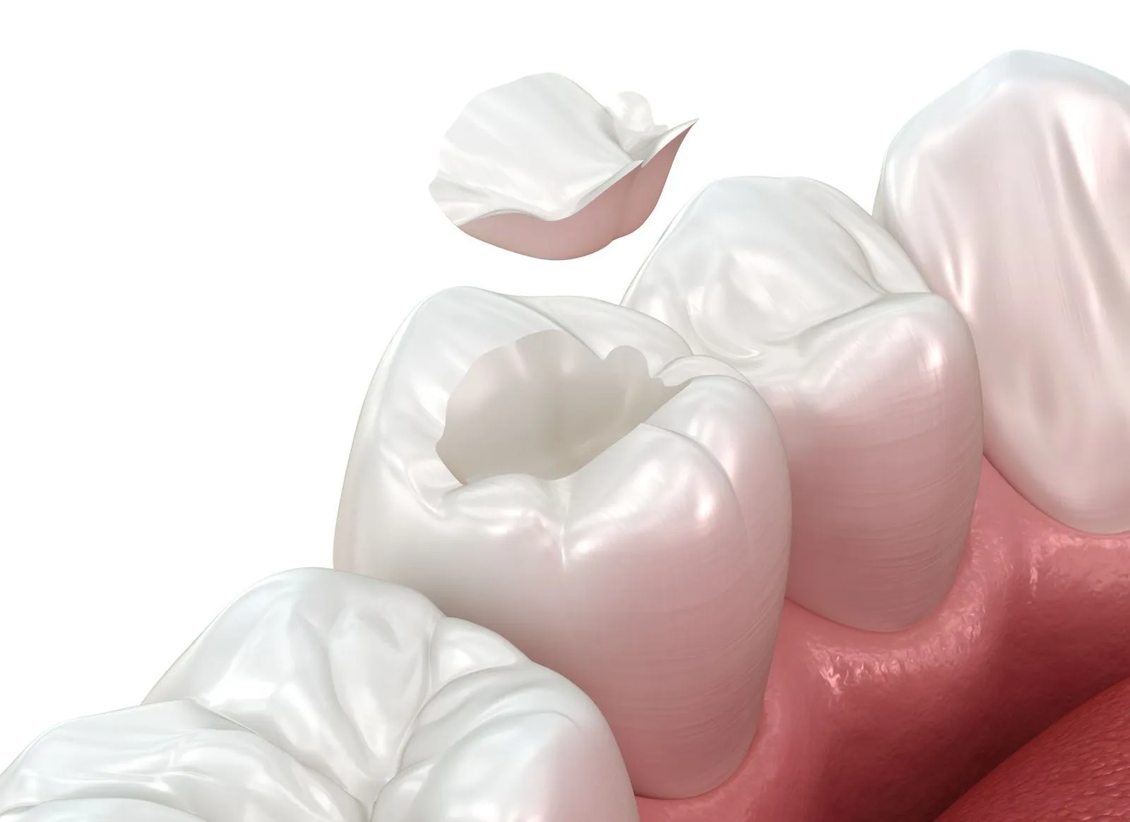 Inlay Restorations For Dental Cavity Repair