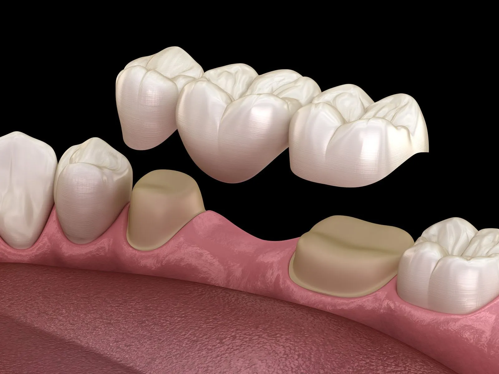 Dental Bridges Illustration For Missing Teeth