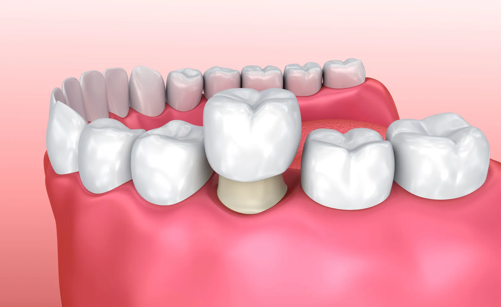 Tooth Cap