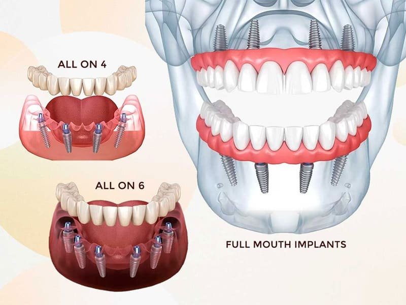 Full Mouth Rehabilitation Using Dental Implants