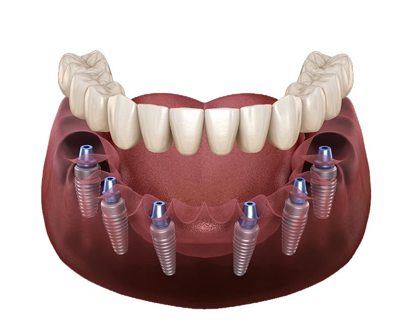 All-on-6 dental implant rehabilitation for full mouth