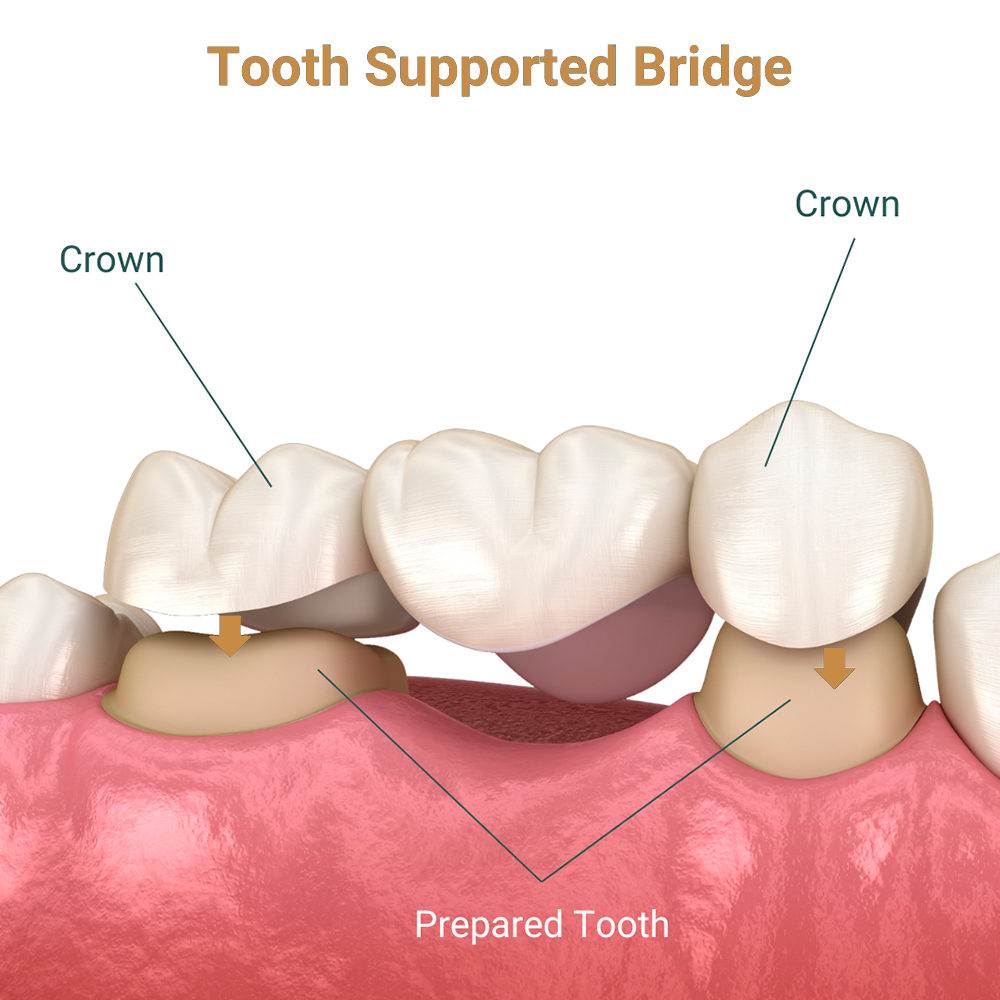 Tooth Supported Bridge