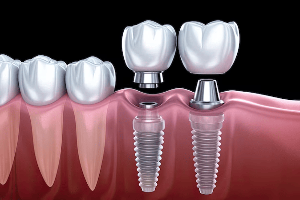 Detailed Tooth Implant Process And Step-By-Step Guide