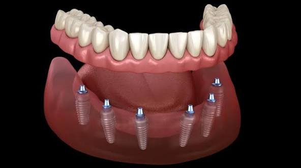 3D Medical Illustration Of An All-On-6 Dental Implant Bridge For The Lower Jaw
