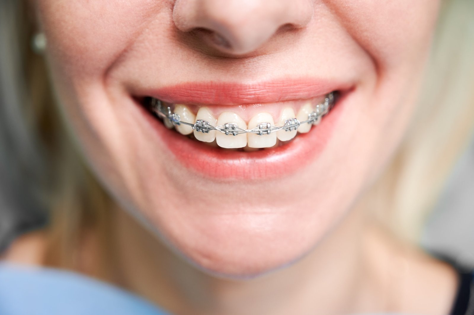 Smiling young woman showing her dental braces