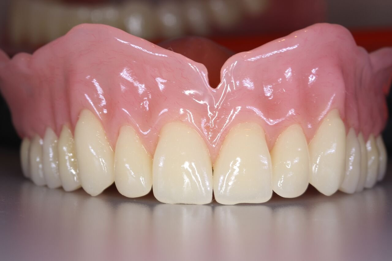 complete upper dentures with natural-looking gums