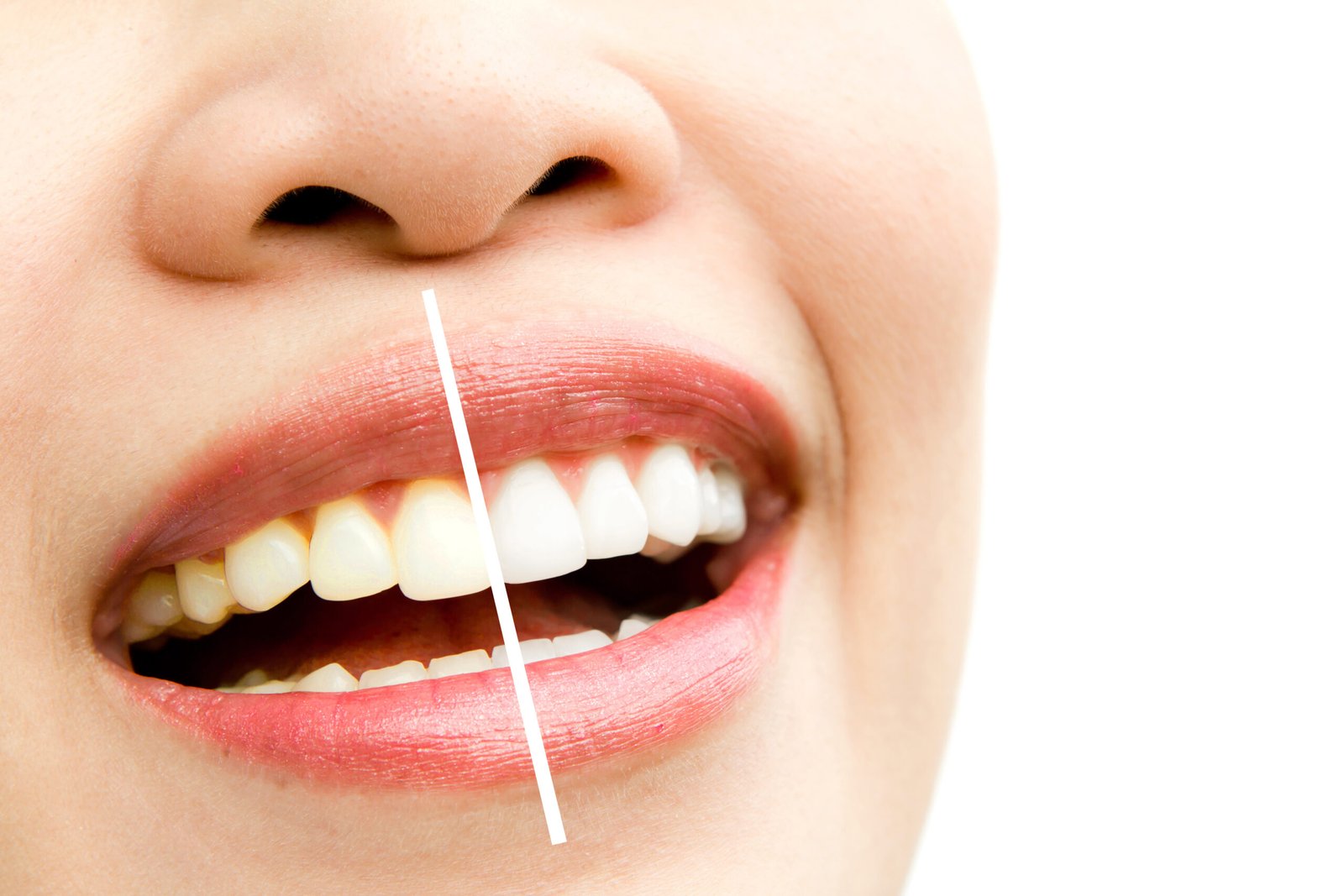 Before And After Comparison Of Teeth Whitening Results